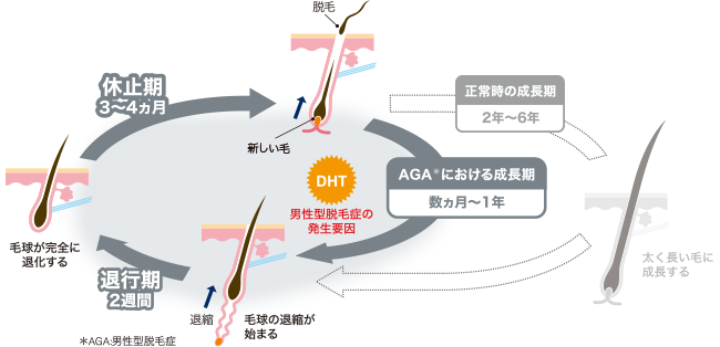 AGAのヘアサイクル:DHTの関与により成長期が短縮し軟毛化が進む模式図