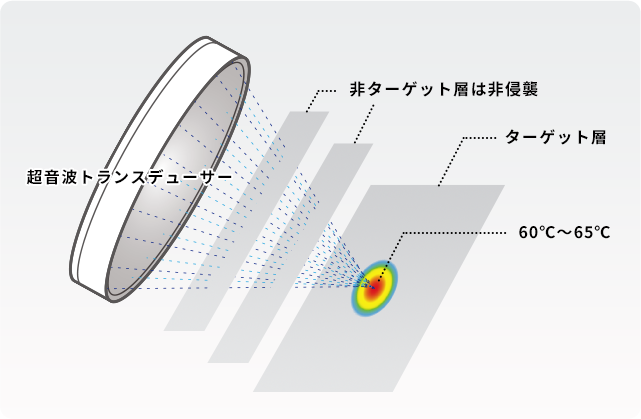 超音波を一点に集束させて照射するハイフの仕組みの図解
