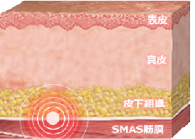 SMAS筋膜とたるみの関係を示す皮膚断面図
