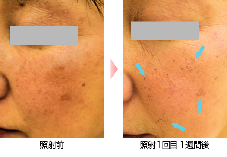 照射後にシミがかさぶたになり剥がれ落ちるまでの経過