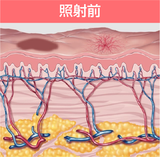 照射前:メラニン色素が沈着しシミ・そばかすができた肌