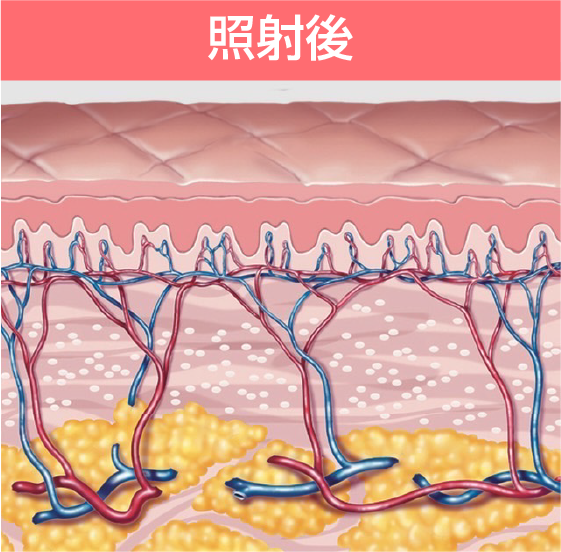 照射後:シミ・そばかすが薄くなりキメの整った肌