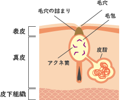 ニキビができる原因の図解（皮脂・毛穴のつまり・アクネ菌）