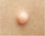 軟性線維腫(アクロコルドン)