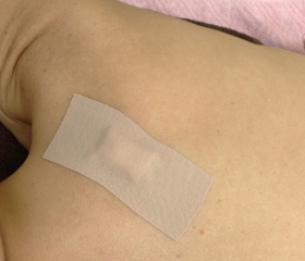 紡錘形切除の手術工程：縫合後の状態