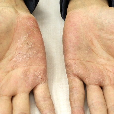 掌蹠膿疱症の症例写真：手のひらの膿疱と鱗屑