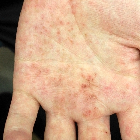 掌蹠膿疱症の症例写真：手のひらの膿疱とかさぶた
