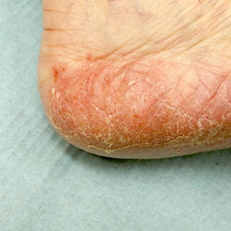 掌蹠膿疱症の症例写真：足の裏の膿疱