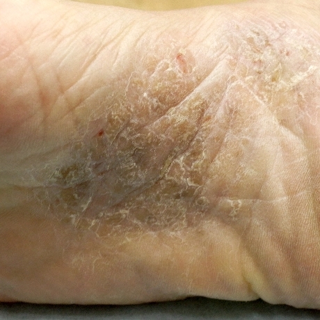 掌蹠膿疱症の症例写真：足の裏の膿疱と皮むけ