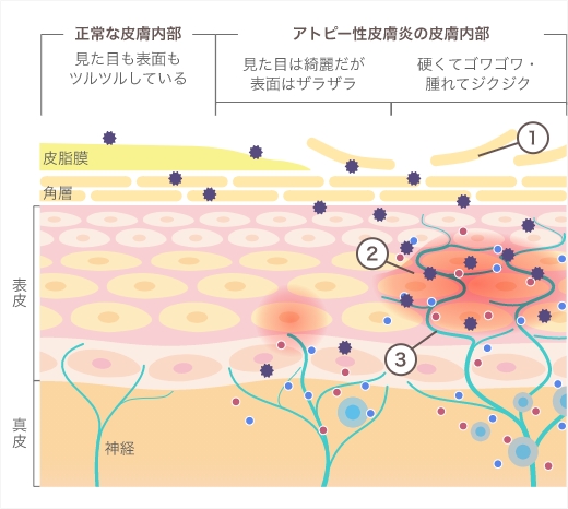 アトピー性皮膚炎の皮膚で起きている炎症のしくみ（バリア機能の低下・皮膚内部の炎症・かゆみ）を示した図
