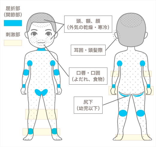 アトピー性皮膚炎で皮疹が現れやすい部位を年齢別に示した図（乳児期・幼少期・思春期および成人期）