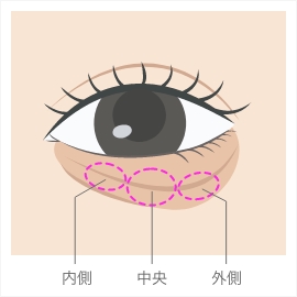 目の下のふくらみ・たるみが生じる仕組みの図解