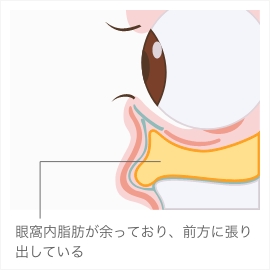 下まぶたの眼窩脂肪（内側・中央・外側）の位置の図解