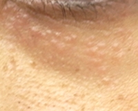 汗管腫の症例写真。下まぶたにできた肌色の平らな盛り上がり
