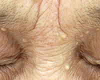 稗粒腫の症例写真。目のまわりにできた1〜2mmの白い粒