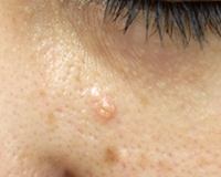 脂腺増殖症の症例写真。オレンジがかった黄色の小さな盛り上がり