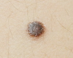 Spitz母斑