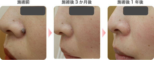 炭酸ガスレーザーによるほくろ除去の症例写真1