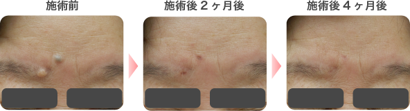 炭酸ガスレーザーによるほくろ除去の症例写真3