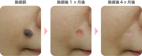 炭酸ガスレーザーによるほくろ除去の症例写真4