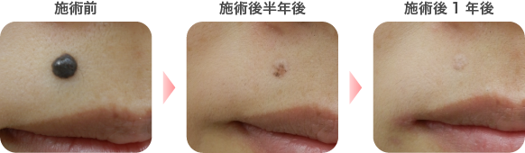炭酸ガスレーザーによるほくろ除去の症例写真5