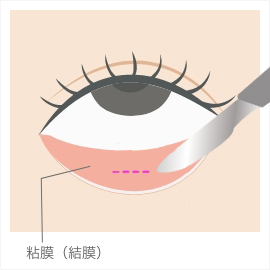 結膜切開の図解