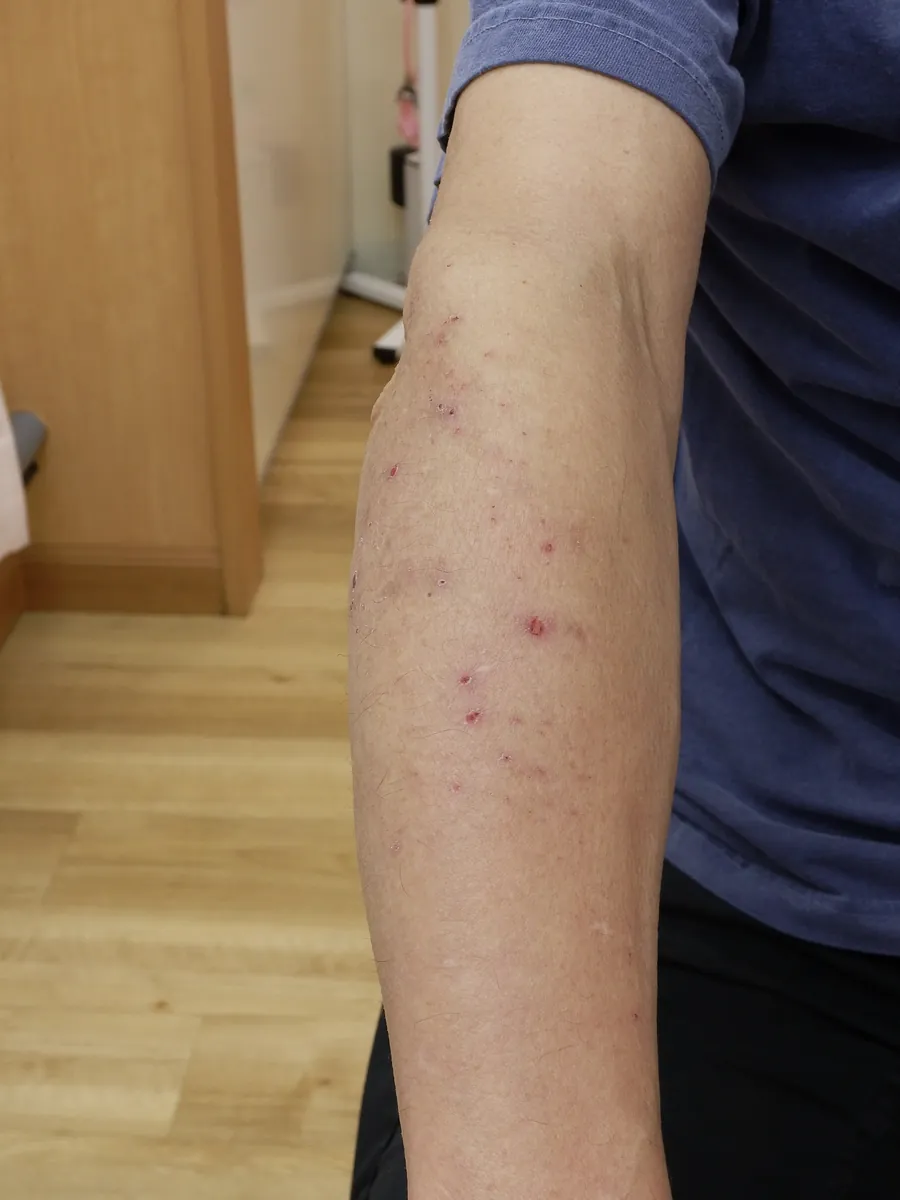 自家感作性皮膚炎の症例写真:前腕にできた散布疹と掻破の跡