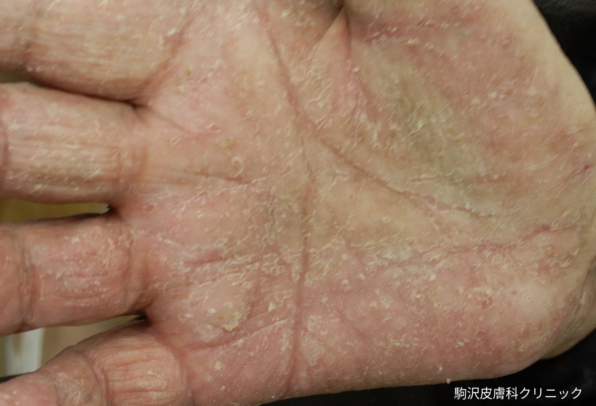 疥癬の写真:手のひら全体に細かい皮むけと赤みが広がっている
