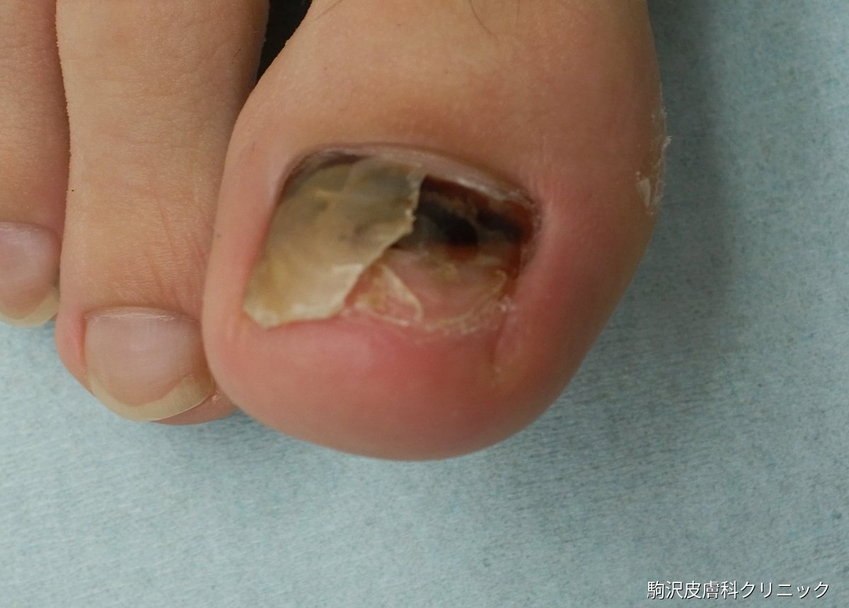 爪の内出血の写真：血腫で浮いた爪が部分的に剥がれ、下に新しい爪が伸びてきている